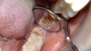 Penanganan Gigi Berlubang